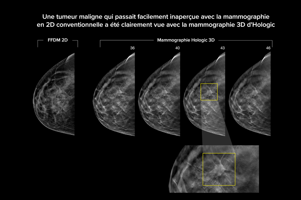 Images cliniques d’une mammographie