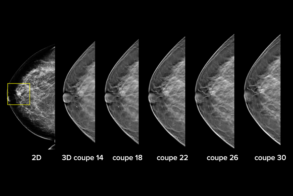 Images cliniques d’une mammographie avec lésion suspecte