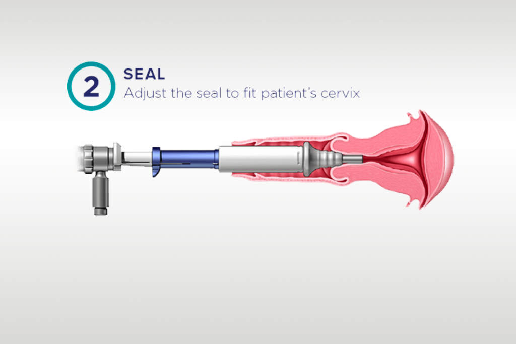 Graphic of Omnilock placed in patient's cervix.
