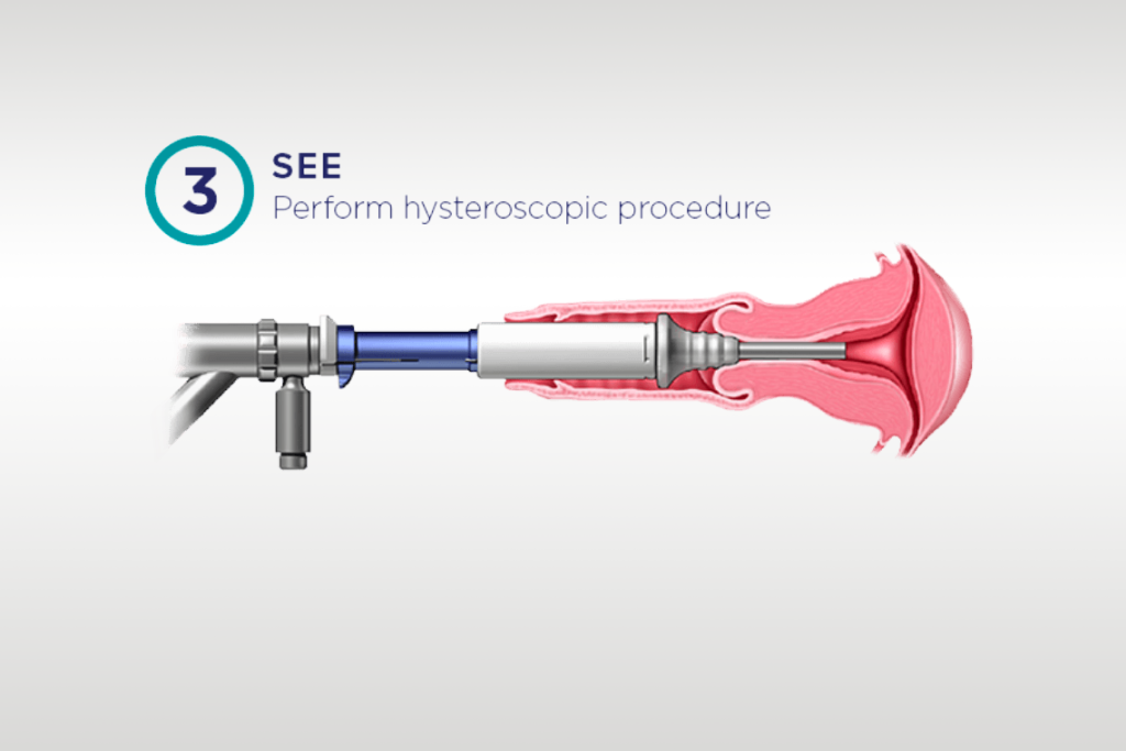 Graphic of Omnilock performed in patient's cervix.