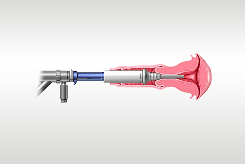 Illustration de l’utilisation l’Omni Lok dans le col de l'utérus de la patiente.