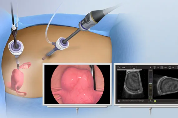 Équipement médical Acessa utilisé sur un patient