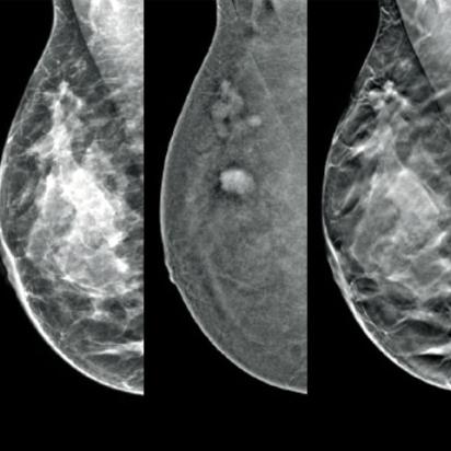 Hologic Hologic I-View™ Contrast Enhanced Imaging